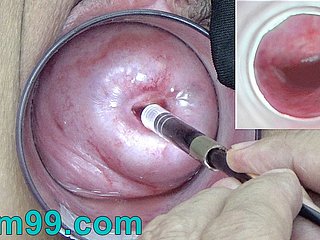 Frosty cámara endoscopio japonés dentro del cuello uterino en coryza vagina Cam